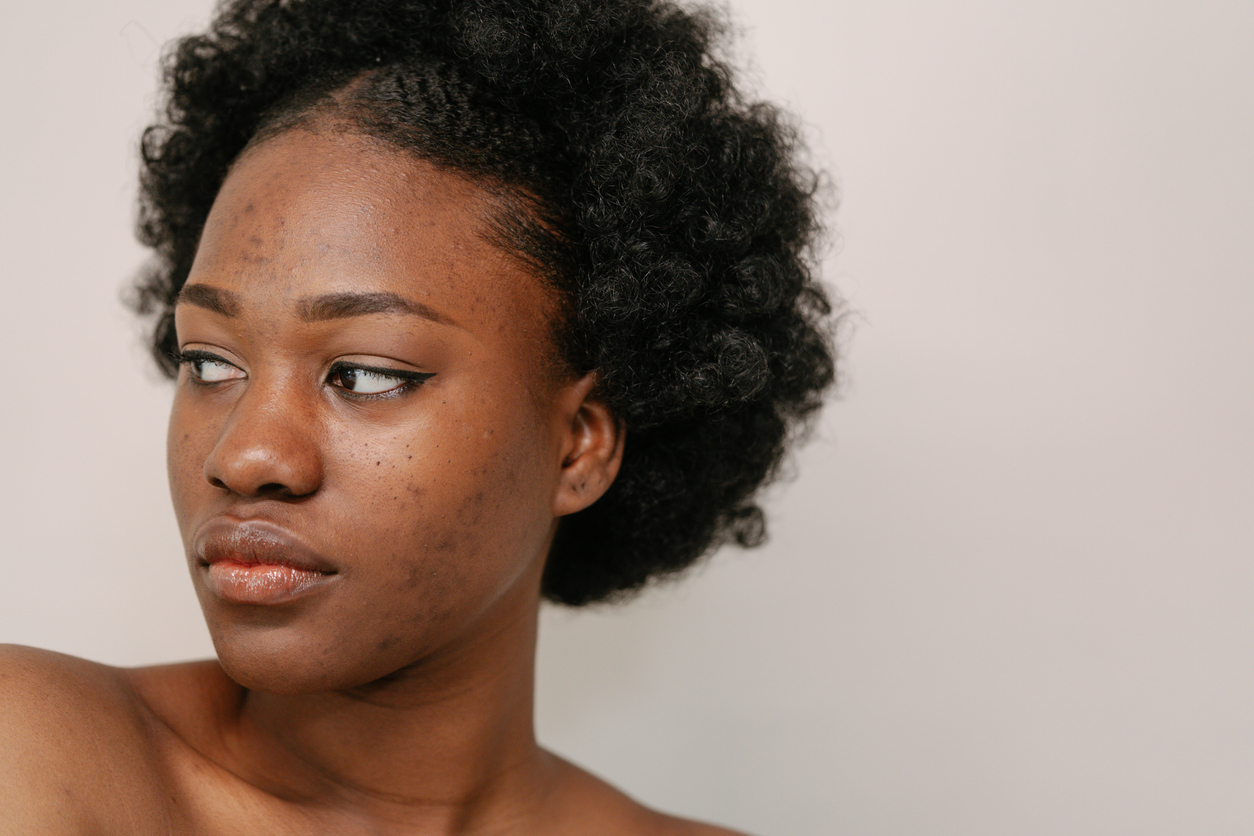 black woman with dark spots treatment to get get rid